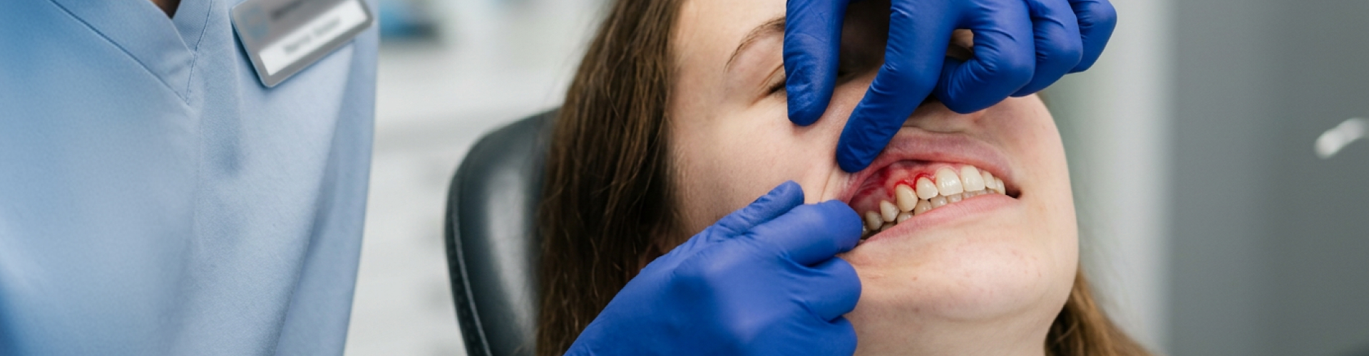 Gloved hands lifting woman's lip to show inflamed gums.